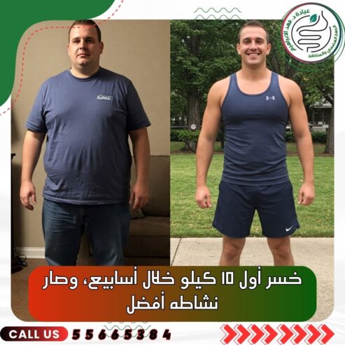 بالون المعدة مع د. فهد الإبراهيم في الكويت